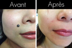 Chirurgie esthétique ablation grain de beauté visage et corps