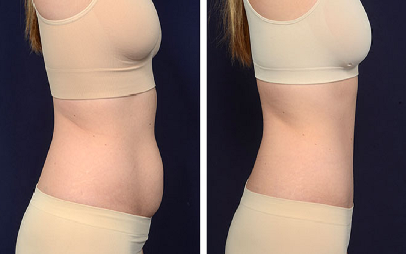 Abdominoplastie Turquie Prix Chirurgie Esthetique Ventre Tout Compris