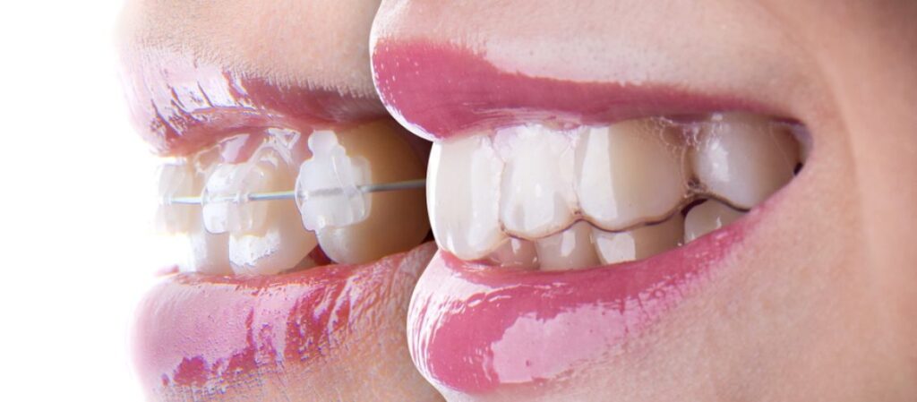 Invisalign Aligner Vos Dents Par Goutti Re Invisible