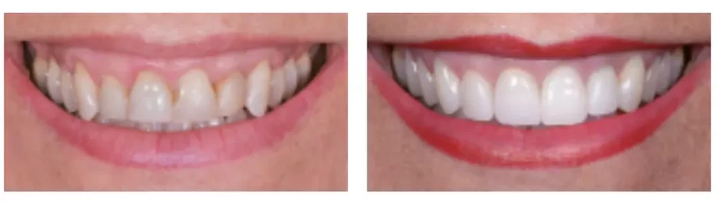 resultats-avant-apres-facettes-dentaires
